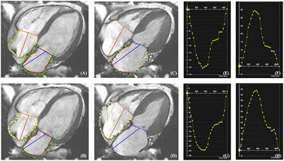 Quantitative Assessment of Left and Right Atrial Strains Using Cardiovascular Magnetic Resonance Based Tissue Tracking